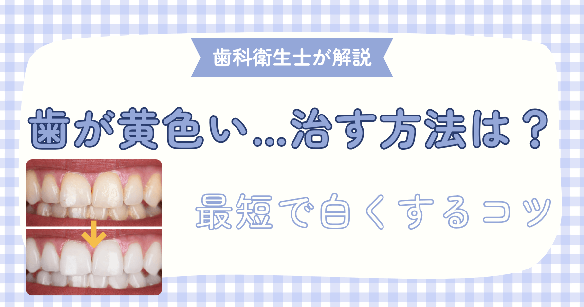 歯が黄色い…どう治す？歯科衛生士が「最短で白くするコツ」を解説